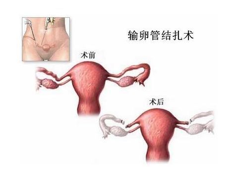 胚胎着床出血